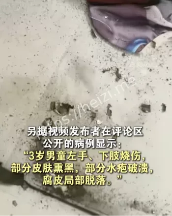手指下肢重创
